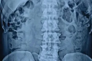 अजीबोगरीब मामला: मरीज के पेट से डॉक्टरों ने निकाला कांच का गिलास