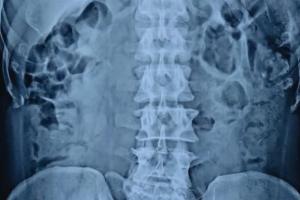 अजीबोगरीब मामला: मरीज के पेट से डॉक्टरों ने निकाला कांच का गिलास