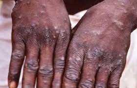 बिहार में भी मंकीपॉक्स के दो संदिग्ध मरीज मिले, हड़कंप, पुणे भेजे गए सैंपल